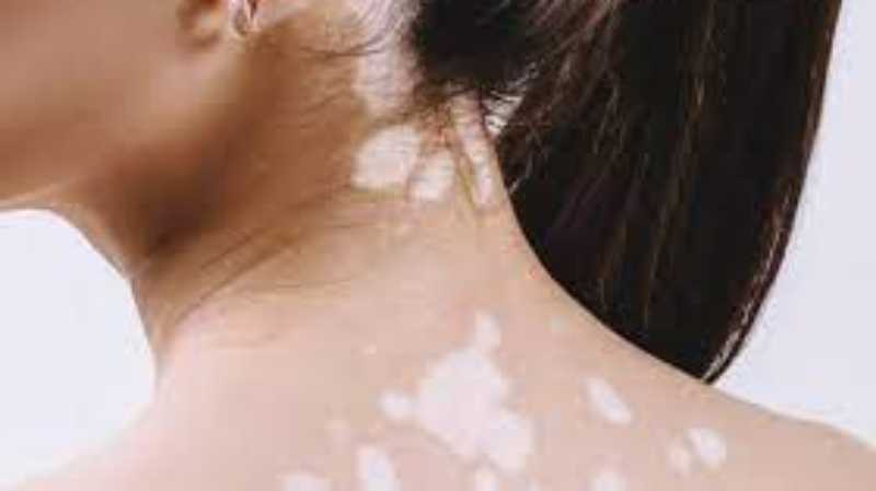 Natural Remedies for Leucoderma (White Leprosy)